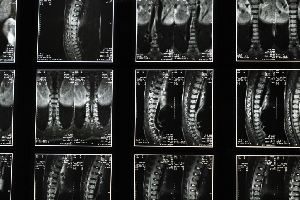 Spinal injury diagnosis and MRI imaging — San Francisco spinal injury attorney John J. Roach helps victims recover full compensation