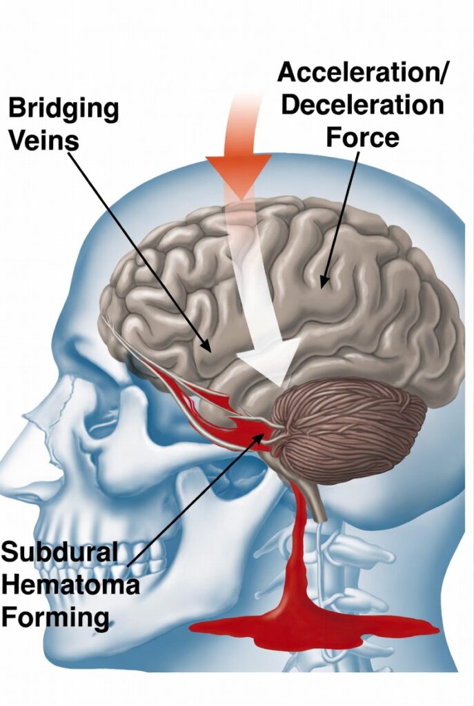 Medical illustration showing how acceleration and deceleration forces cause bridging veins to tear and a subdural hematoma to form — common in car accidents