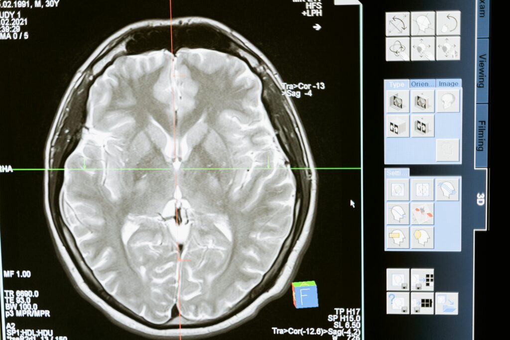 Brain MRI scan used to diagnose traumatic brain injury — San Francisco TBI attorney John J. Roach works with top neurologists to document injuries