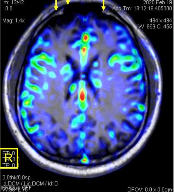 Colorized brain perfusion scan showing an area of reduced blood flow in the frontal lobes, from a follow-up MRI