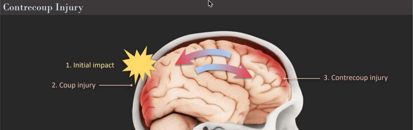 Diagram illustrating coup-contrecoup brain injury: the brain is injured both at the point of initial impact and, as it rebounds inside the skull, at the opposite side